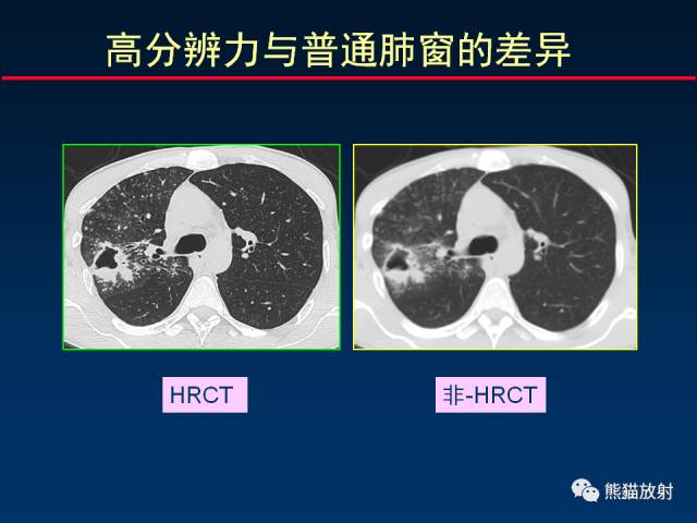 【PPT】CT扫描及后处理技术在胸部疾病中的价值