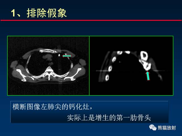 【PPT】CT扫描及后处理技术在胸部疾病中的价值