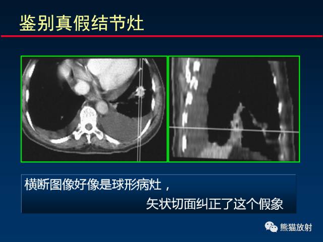 【PPT】CT扫描及后处理技术在胸部疾病中的价值