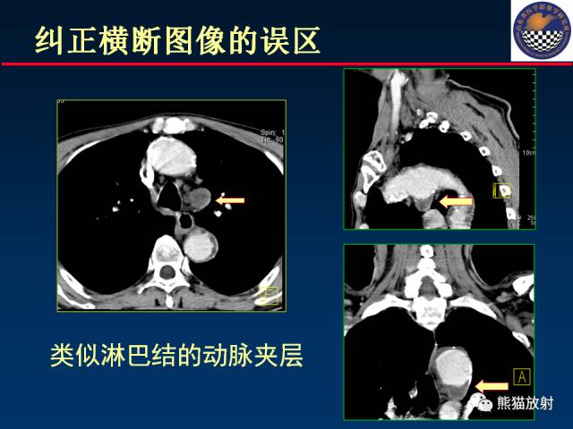 【PPT】CT扫描及后处理技术在胸部疾病中的价值