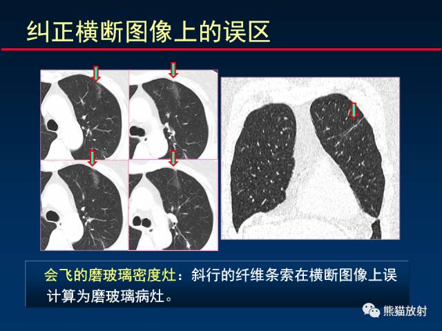 【PPT】CT扫描及后处理技术在胸部疾病中的价值