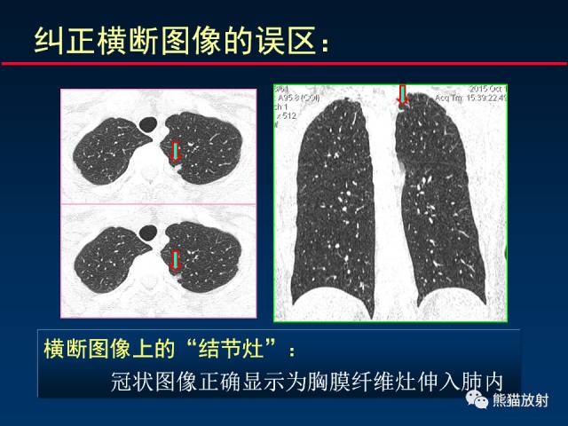 【PPT】CT扫描及后处理技术在胸部疾病中的价值