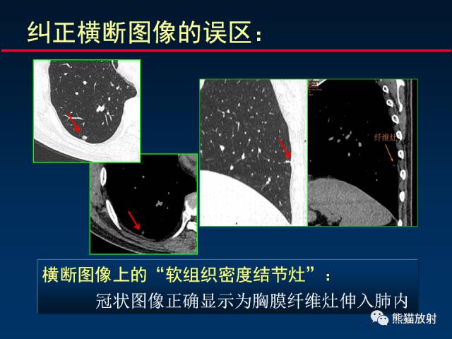 【PPT】CT扫描及后处理技术在胸部疾病中的价值
