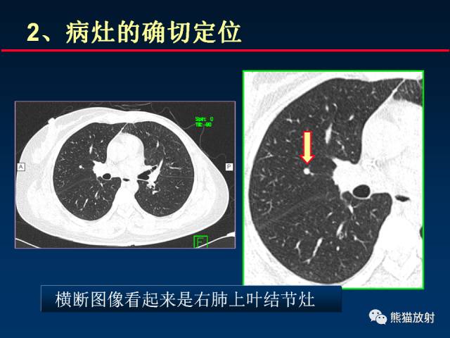 【PPT】CT扫描及后处理技术在胸部疾病中的价值