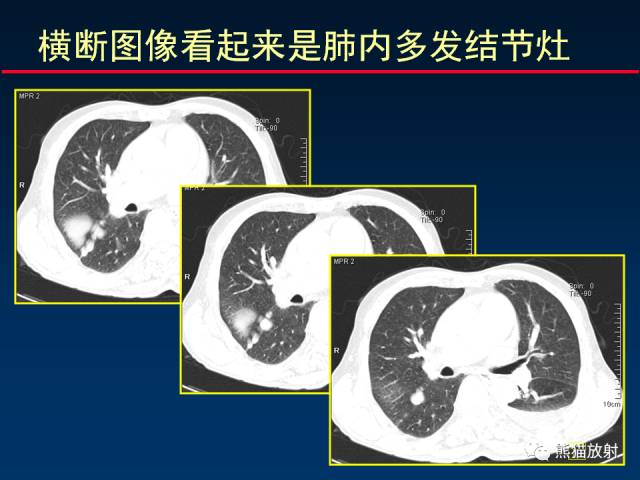 【PPT】CT扫描及后处理技术在胸部疾病中的价值