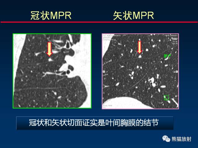 【PPT】CT扫描及后处理技术在胸部疾病中的价值