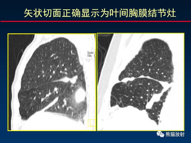 【PPT】CT扫描及后处理技术在胸部疾病中的价值