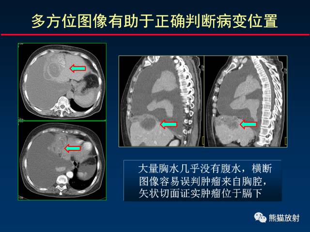 【PPT】CT扫描及后处理技术在胸部疾病中的价值