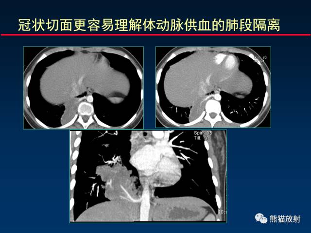 【PPT】CT扫描及后处理技术在胸部疾病中的价值