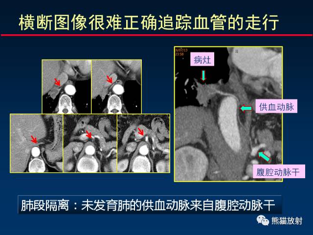 【PPT】CT扫描及后处理技术在胸部疾病中的价值