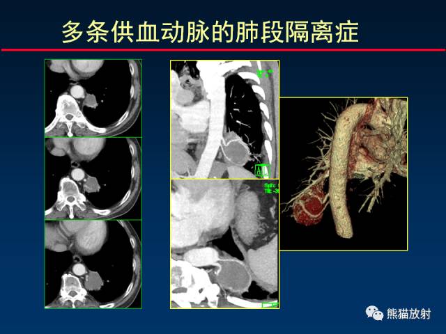 【PPT】CT扫描及后处理技术在胸部疾病中的价值