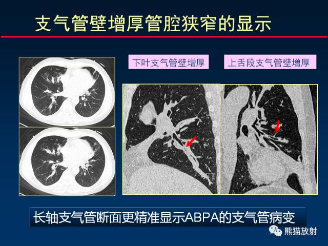 【PPT】CT扫描及后处理技术在胸部疾病中的价值