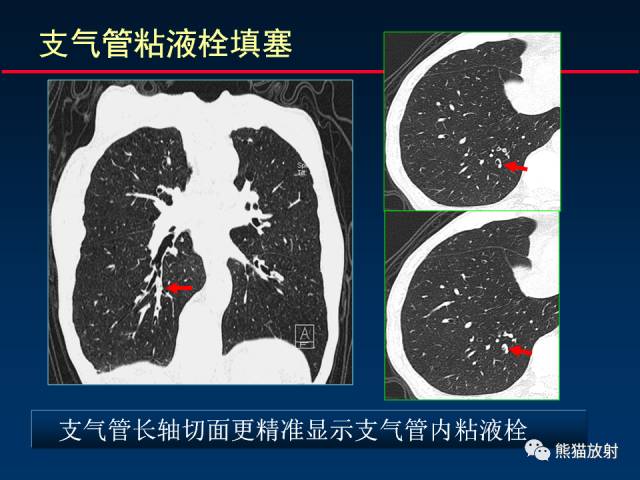 【PPT】CT扫描及后处理技术在胸部疾病中的价值