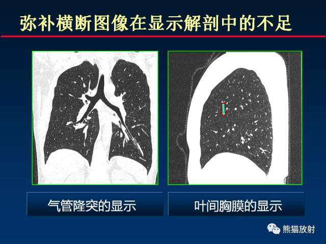【PPT】CT扫描及后处理技术在胸部疾病中的价值