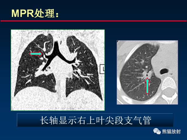 【PPT】CT扫描及后处理技术在胸部疾病中的价值