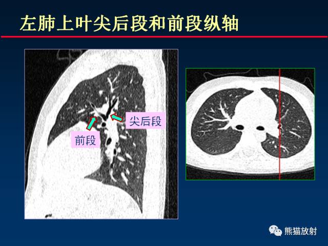【PPT】CT扫描及后处理技术在胸部疾病中的价值