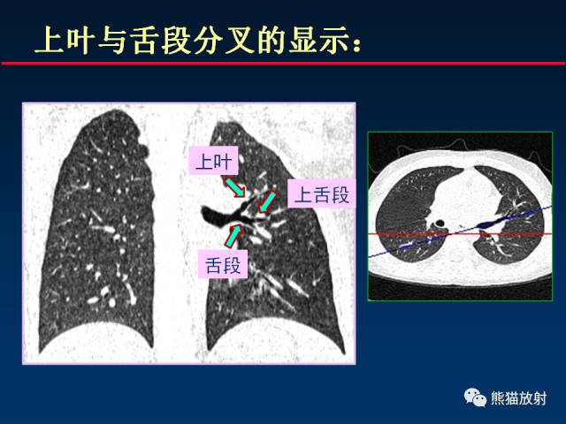 【PPT】CT扫描及后处理技术在胸部疾病中的价值