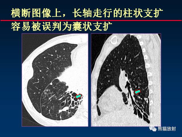 【PPT】CT扫描及后处理技术在胸部疾病中的价值