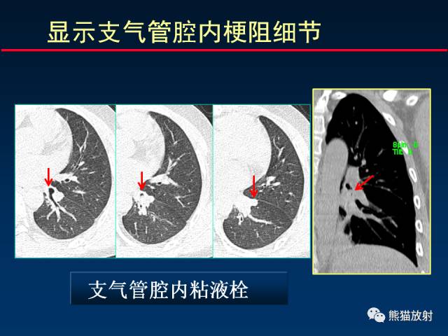 【PPT】CT扫描及后处理技术在胸部疾病中的价值