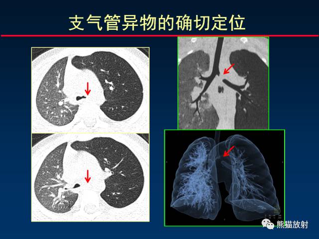 【PPT】CT扫描及后处理技术在胸部疾病中的价值