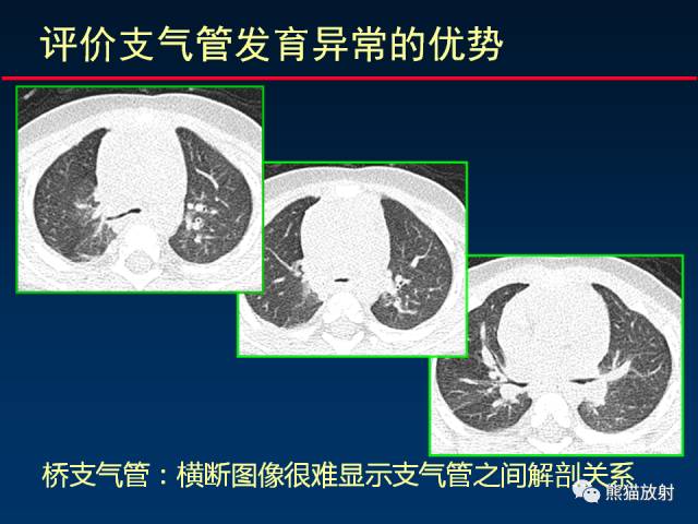 【PPT】CT扫描及后处理技术在胸部疾病中的价值