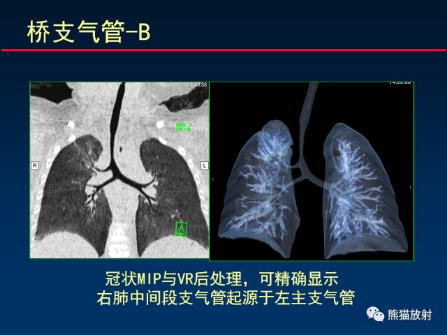 【PPT】CT扫描及后处理技术在胸部疾病中的价值