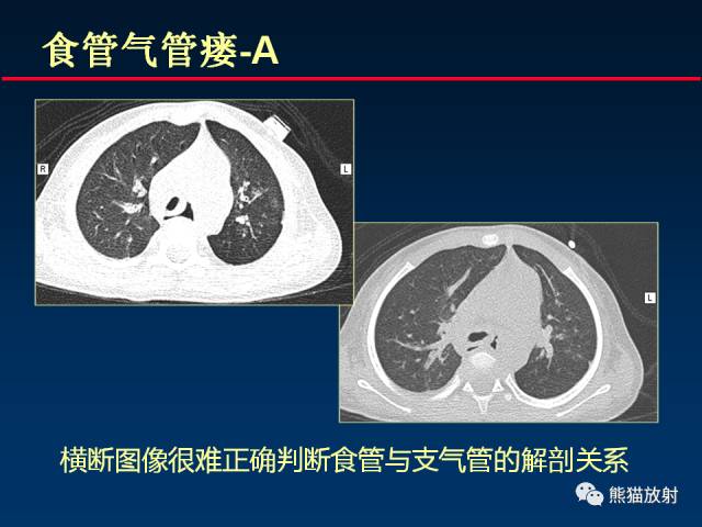 【PPT】CT扫描及后处理技术在胸部疾病中的价值