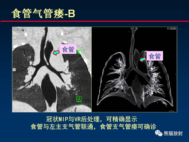 【PPT】CT扫描及后处理技术在胸部疾病中的价值