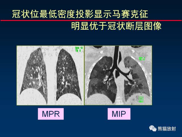 【PPT】CT扫描及后处理技术在胸部疾病中的价值