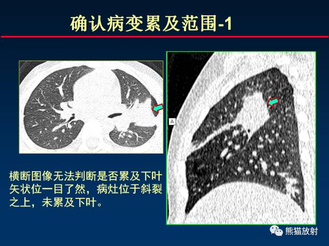 【PPT】CT扫描及后处理技术在胸部疾病中的价值