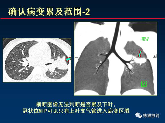【PPT】CT扫描及后处理技术在胸部疾病中的价值