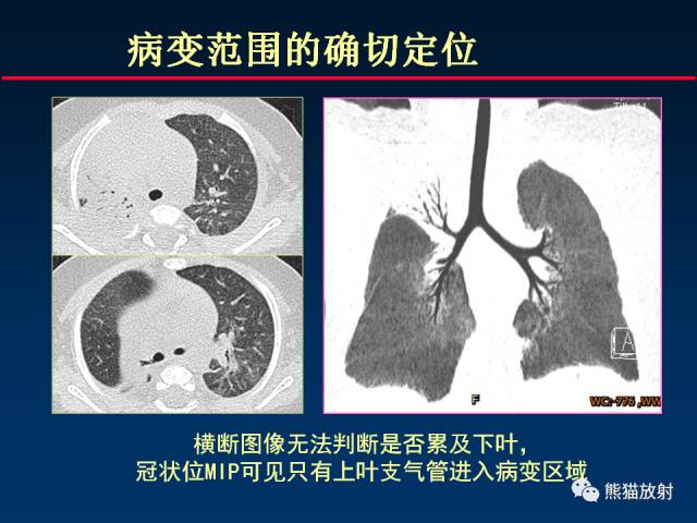 【PPT】CT扫描及后处理技术在胸部疾病中的价值