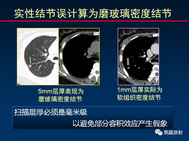 【PPT】CT扫描及后处理技术在胸部疾病中的价值