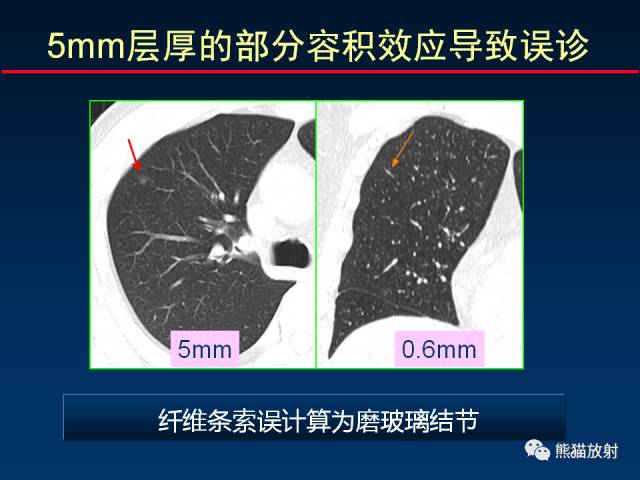 【PPT】CT扫描及后处理技术在胸部疾病中的价值
