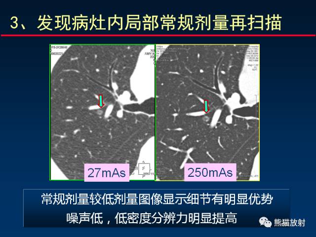 【PPT】CT扫描及后处理技术在胸部疾病中的价值