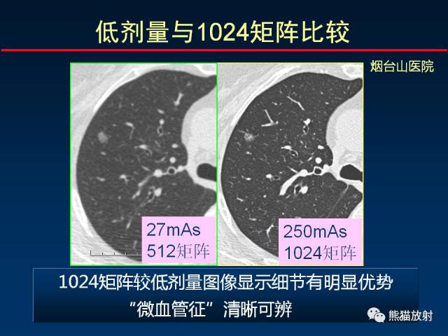 【PPT】CT扫描及后处理技术在胸部疾病中的价值