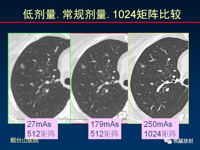 【PPT】CT扫描及后处理技术在胸部疾病中的价值