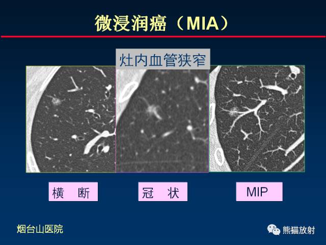 【PPT】CT扫描及后处理技术在胸部疾病中的价值