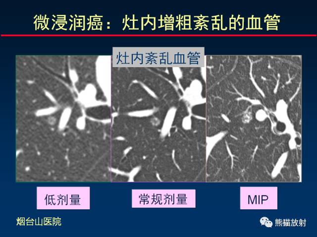 【PPT】CT扫描及后处理技术在胸部疾病中的价值