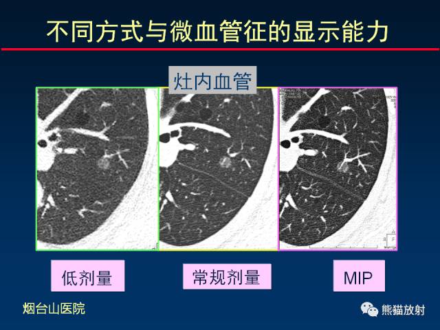 【PPT】CT扫描及后处理技术在胸部疾病中的价值
