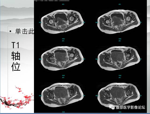 【病例】输卵管脓肿1例MR影像表现