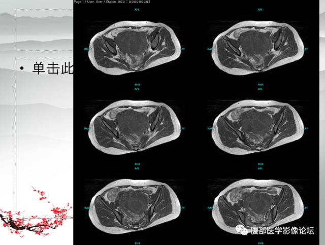 【病例】输卵管脓肿1例MR影像表现