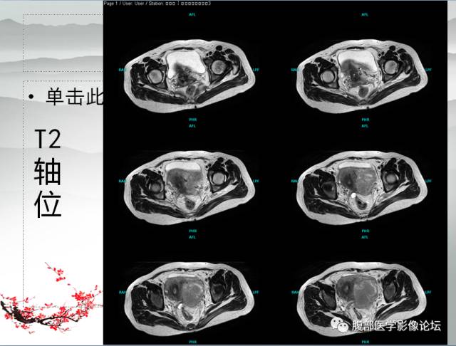 【病例】输卵管脓肿1例MR影像表现