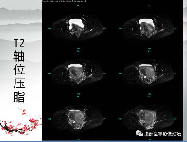 【病例】输卵管脓肿1例MR影像表现
