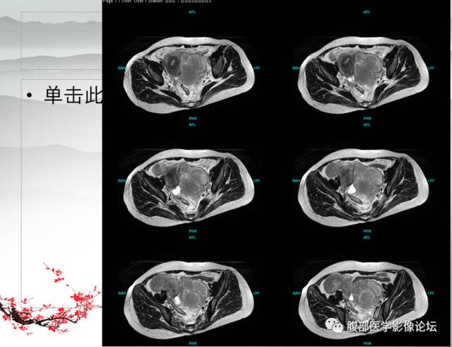 【病例】输卵管脓肿1例MR影像表现
