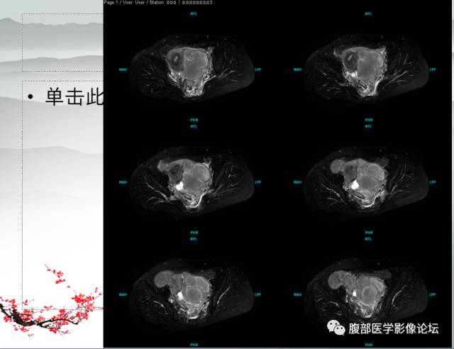 【病例】输卵管脓肿1例MR影像表现