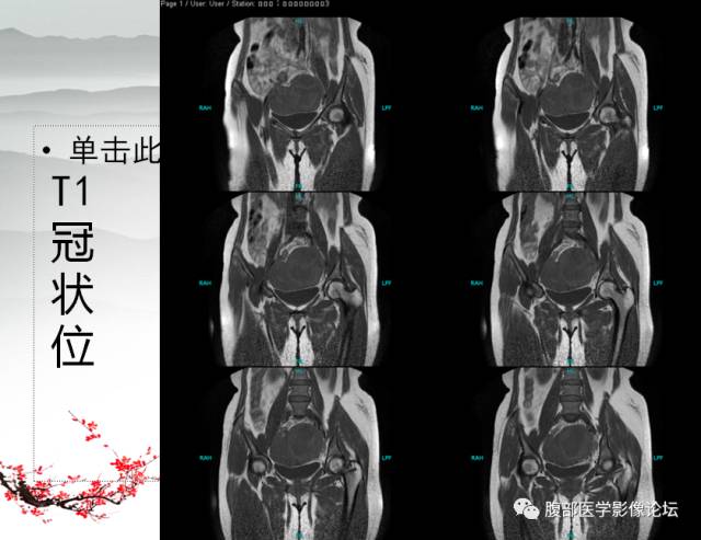 【病例】输卵管脓肿1例MR影像表现