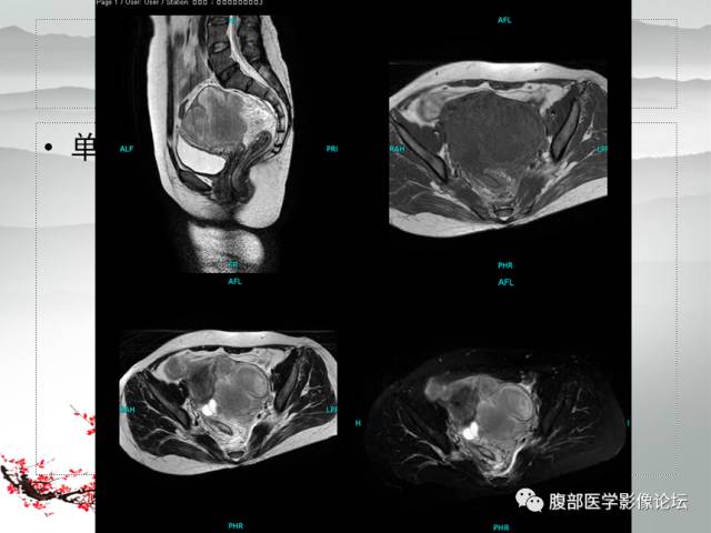 【病例】输卵管脓肿1例MR影像表现