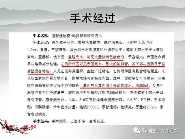 【病例】输卵管脓肿1例MR影像表现