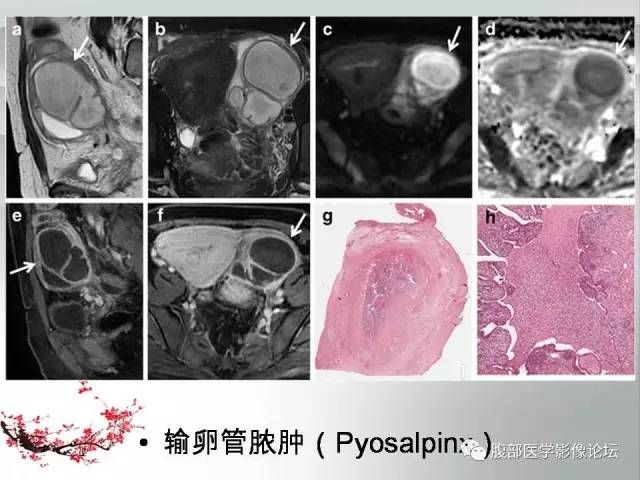 【病例】输卵管脓肿1例MR影像表现